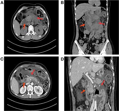 Wernicke's encephalopathy after acute pancreatitis with upper gastrointestinal obstruction: A case report and literature review